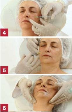Процедура биоревитализация кожи