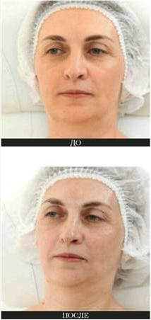 Биоревитализация кожи до и после