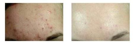 Акне средней степени тяжести - до и после проведения фотодинамической терапии кожи
