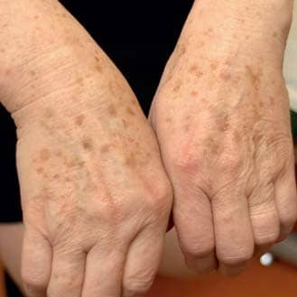 Пигментация кожи рук