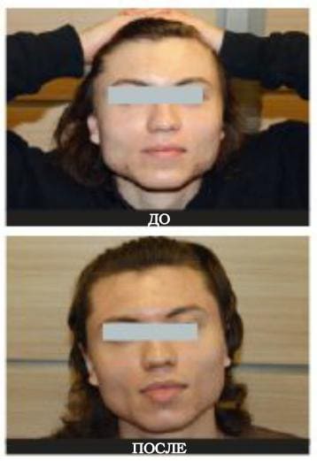 Коррекция кожи с постакне - фото до и после