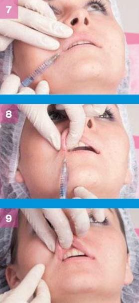 Процедура коррекции губ