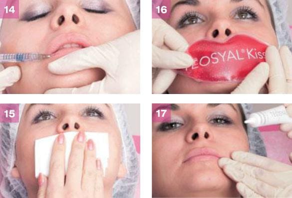 Процедура коррекции губ