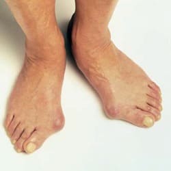 Косточки на стопах ног