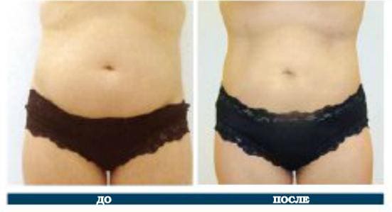 Фото до и после однократной процедуры коррекции жировых отложений аппаратом Liposonix