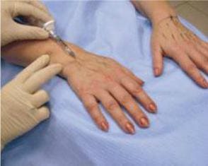 Коррекция возрастных изменений тыльной поверхности кистей рук гиалуроновой кислотой