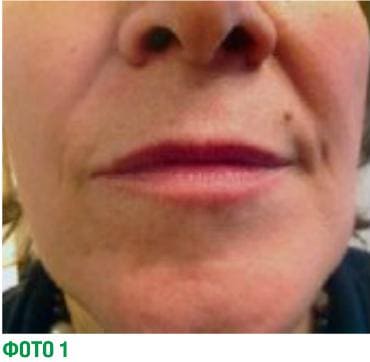 Коррекция проявления морщин в области рта