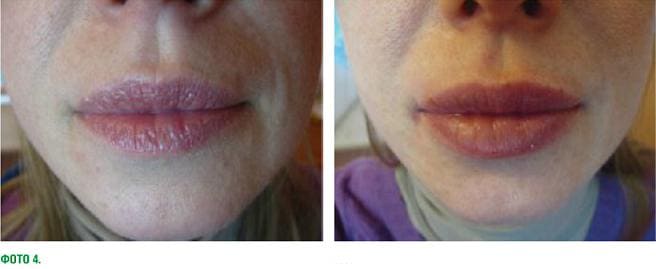 Фотография до и после процедуры введения филлеров для увеличения и создания контура губ
