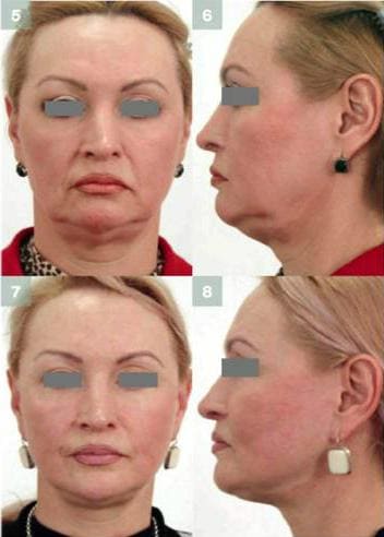 Фото до и после операции по омоложению лица и шеи