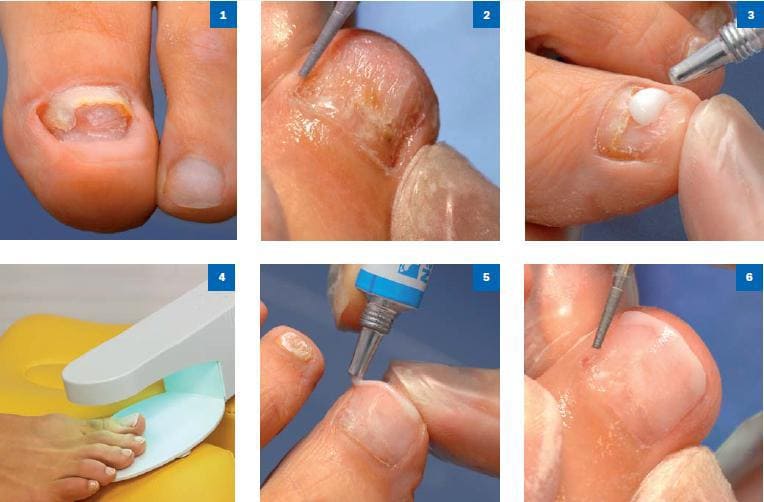 Процедура протезирования ногтей на ногах