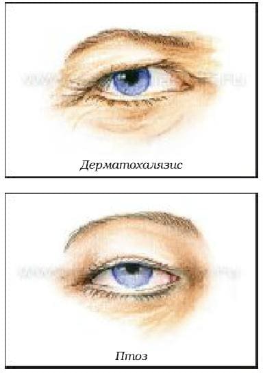 Возрастные изменениях в зоне глаз